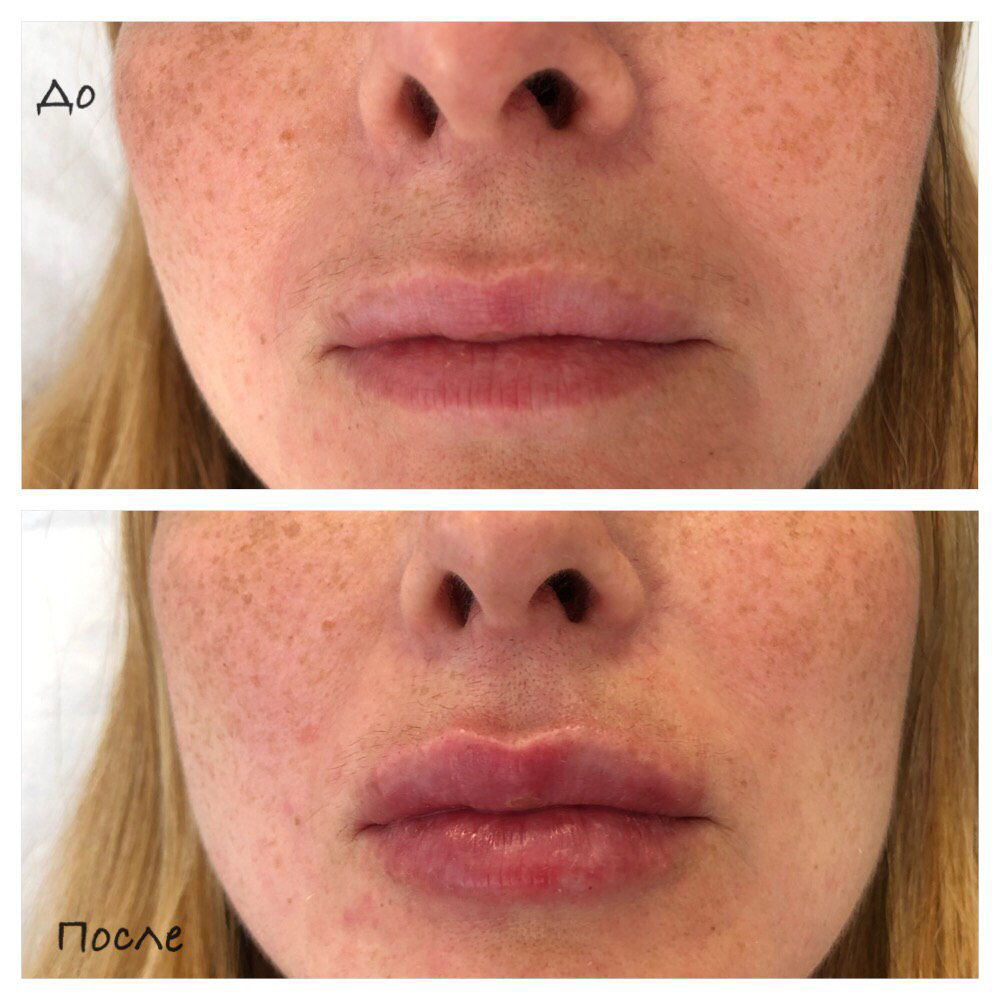 Что стоит узнать перед увеличением губ гиалуроновой кислотой?